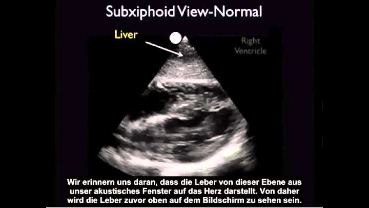 Anleitung Kardiologische Echokardiografie Subxiphoidale Darstellung Youtube